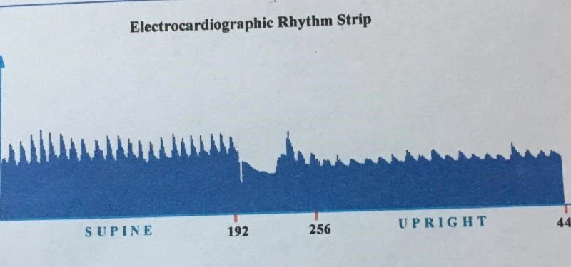 Healthy Electrocardiographic Rhythm
