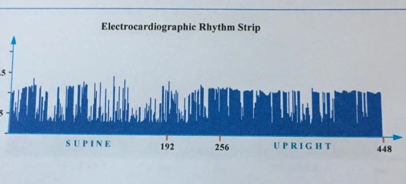 Irregular Electrocardiographic Rhythm