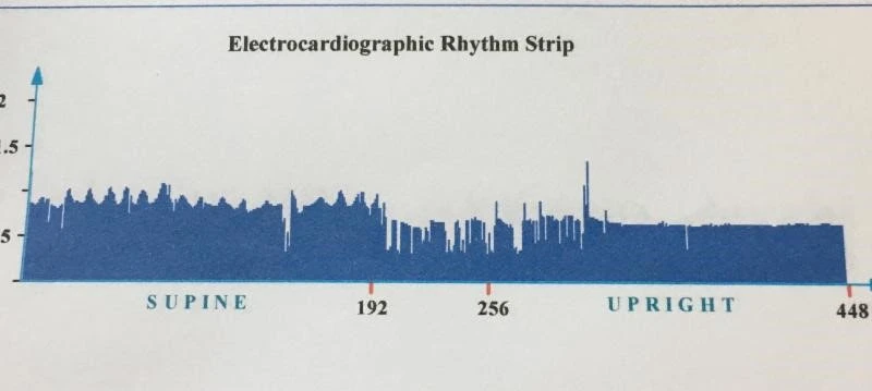 Irregular Electrocardiographic Rhythm
