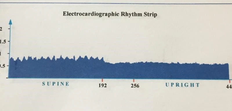 Healthy Electrocardiographic Rhythm